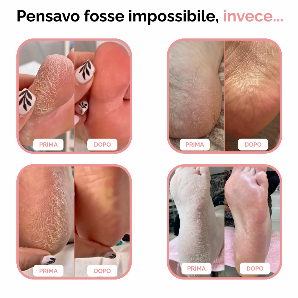 PediGlow™ Pro - Rimuovi Calli per Sempre